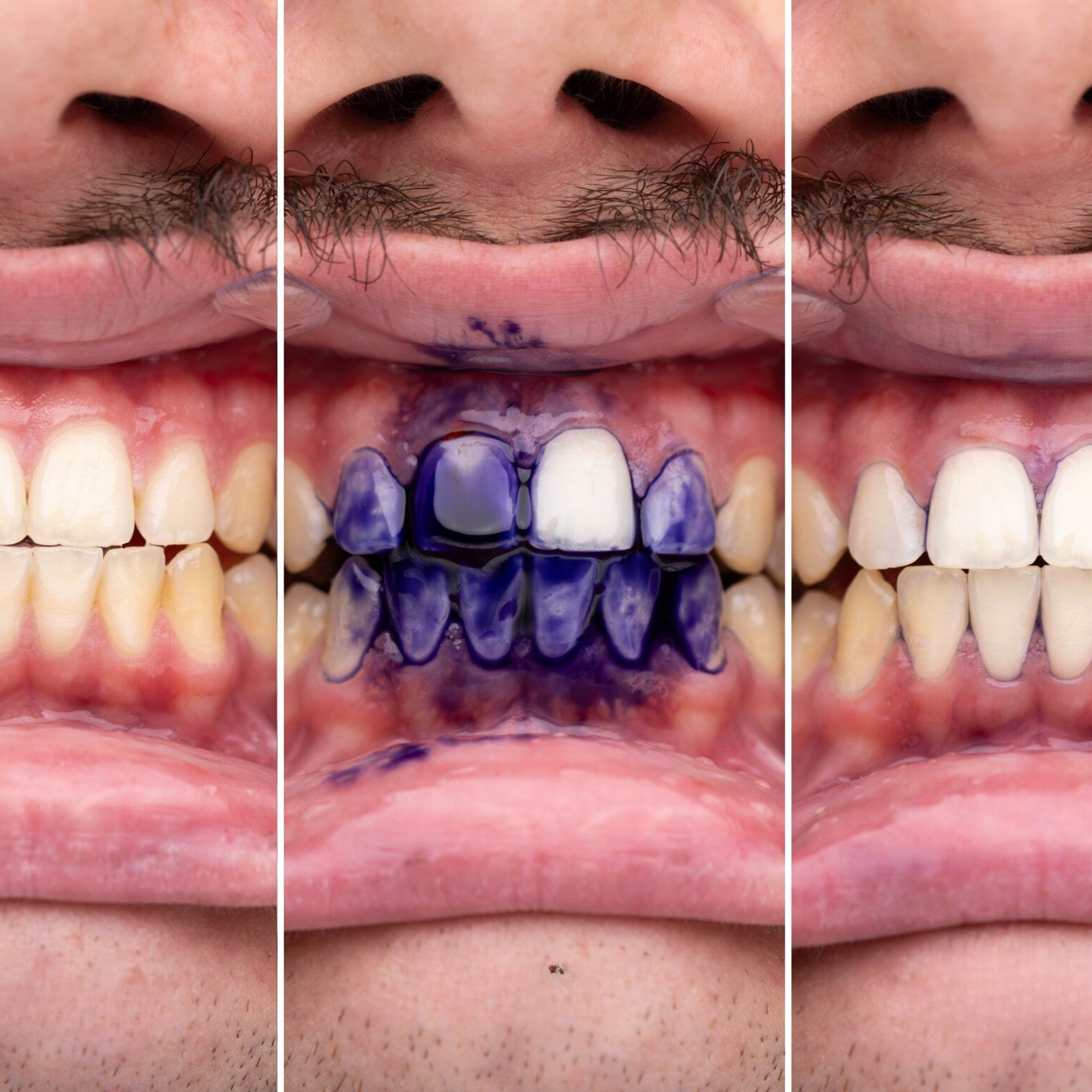 V24™ Instant Teeth Whitening Serum